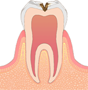 虫歯レベル2（C2）