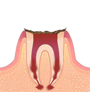 虫歯レベル4（C4）