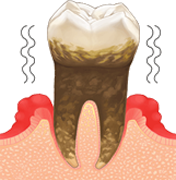 歯周病末期